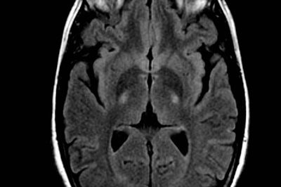 594_nuevo-ensayo-clinico-ozanezumab.jpg