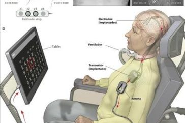 802_una-paciente-con-ela-se-comunica-gracias-a-un-implante-cerebral-.jpg